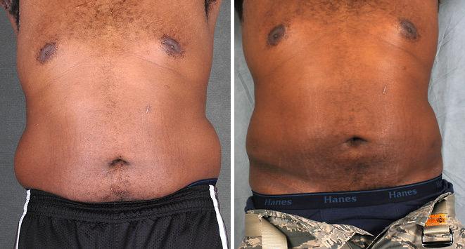 Liposuction Before and After Photos in Omaha, NE, Case 4185