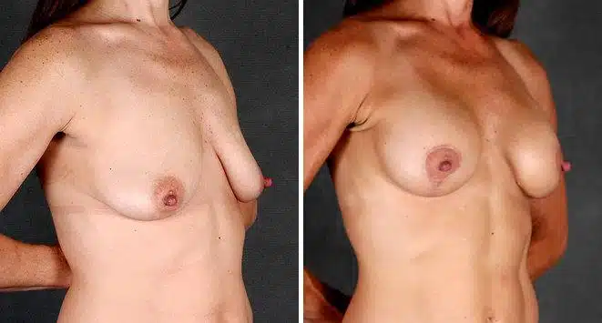 Breast Augmentation Before and After Photos in Omaha, NE, Case 4306