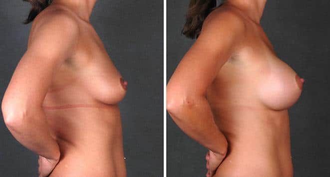 Breast Augmentation Before and After Photos in Omaha, NE, Case 4339