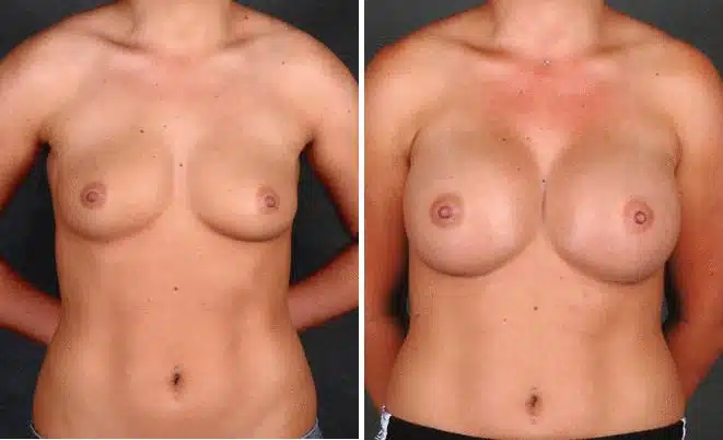 Breast Augmentation Before and After Photos in Omaha, NE, Case 4353