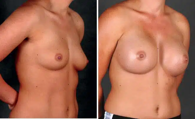 Breast Augmentation Before and After Photos in Omaha, NE, Case 4353