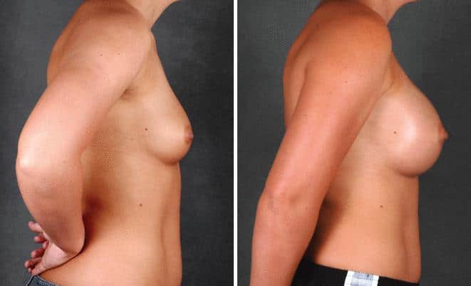 Breast Augmentation Before and After Photos in Omaha, NE, Case 4353