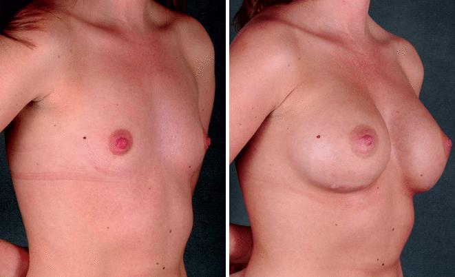 Breast Augmentation Before and After Photos in Omaha, NE, Case 4377