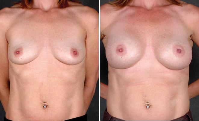 Breast Augmentation Before and After Photos in Omaha, NE, Case 4397