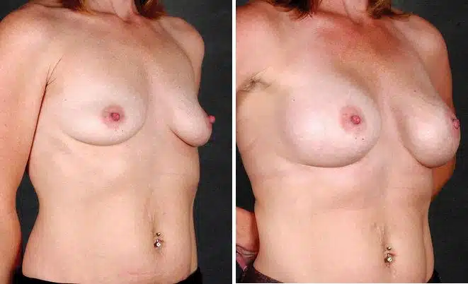 Breast Augmentation Before and After Photos in Omaha, NE, Case 4397