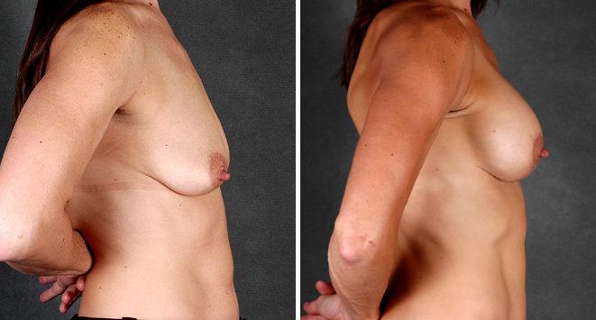 Breast Augmentation Before and After Photos in Omaha, NE, Case 4306