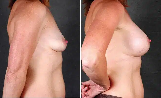 Breast Augmentation Before and After Photos in Omaha, NE, Case 4397