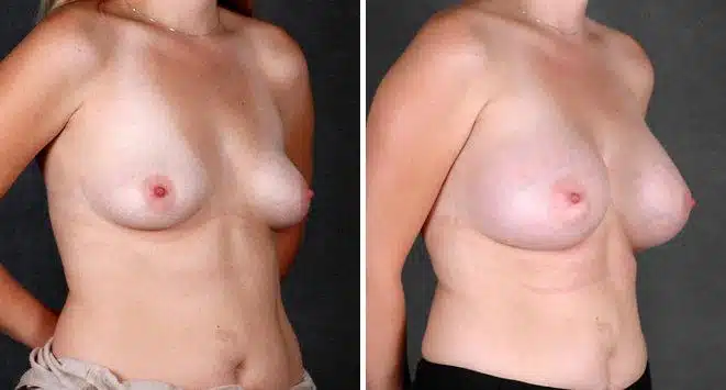 Breast Augmentation Before and After Photos in Omaha, NE, Case 4437