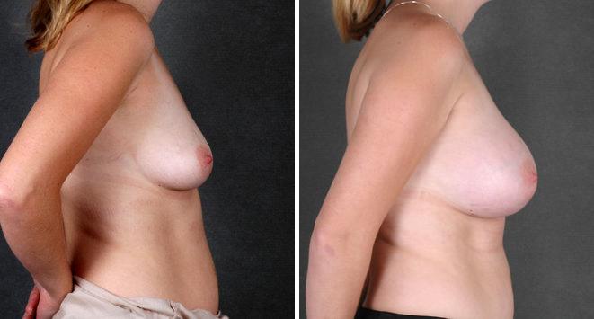 Breast Augmentation Before and After Photos in Omaha, NE, Case 4437