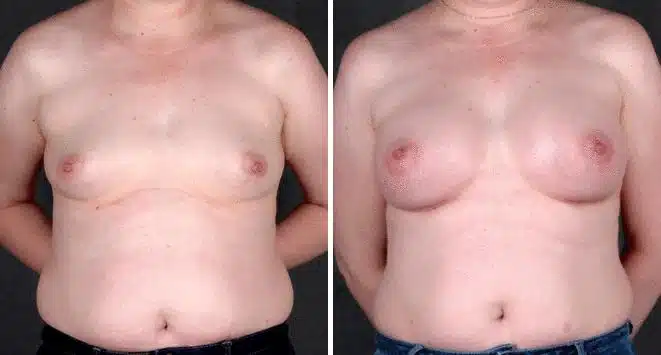 Breast Augmentation Before and After Photos in Omaha, NE, Case 4453