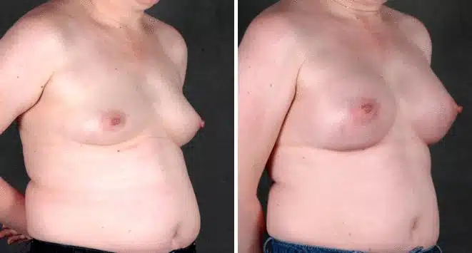 Breast Augmentation Before and After Photos in Omaha, NE, Case 4453