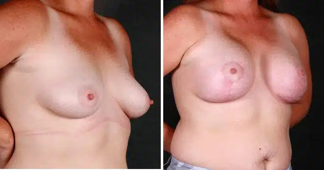 Breast Augmentation Before and After Photos in Omaha, NE, Case 4478