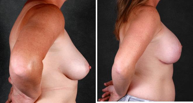 Breast Augmentation Before and After Photos in Omaha, NE, Case 4478