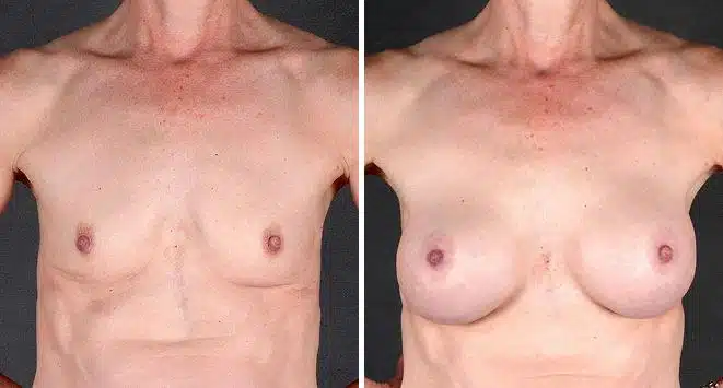 Breast Augmentation Before and After Photos in Omaha, NE, Case 4320