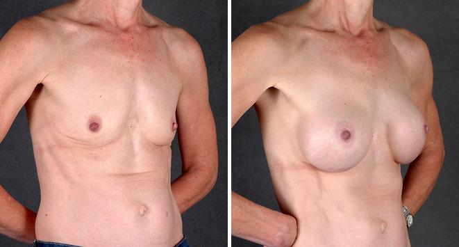 Breast Augmentation Before and After Photos in Omaha, NE, Case 4320