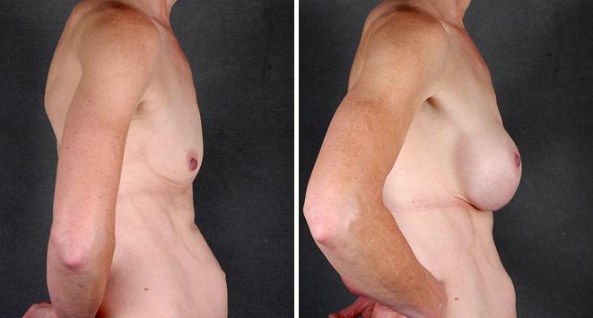 Breast Augmentation Before and After Photos in Omaha, NE, Case 4320