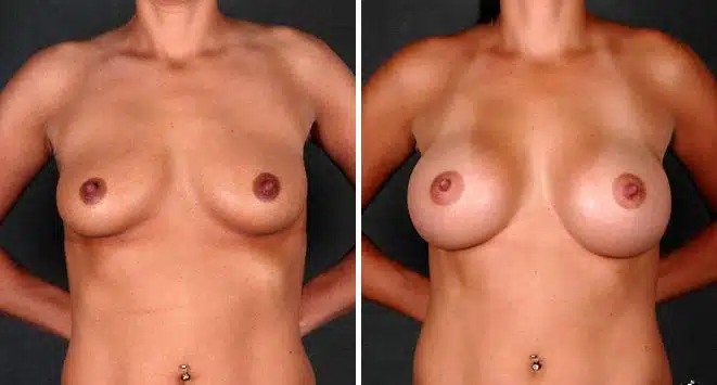 Breast Augmentation Before and After Photos in Omaha, NE, Case 4339