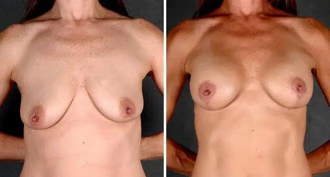 Breast Augmentation Before and After Photos in Omaha, NE, Case 4306