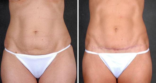 Mini Tummy Tuck Before and After Photos in Omaha, NE, Case 4384