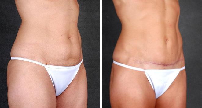 Mini Tummy Tuck Before and After Photos in Omaha, NE, Case 4384