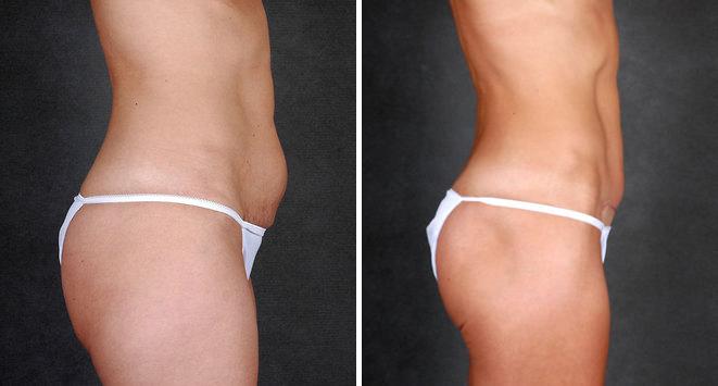 Mini Tummy Tuck Before and After Photos in Omaha, NE, Case 4384