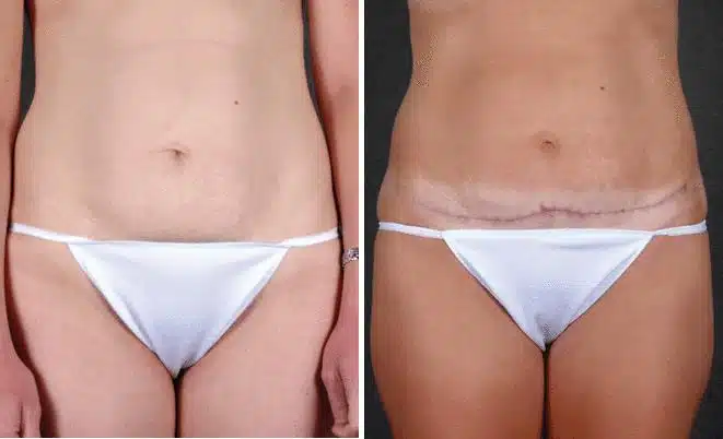 Mini Tummy Tuck Before and After Photos in Omaha, NE, Case 4319