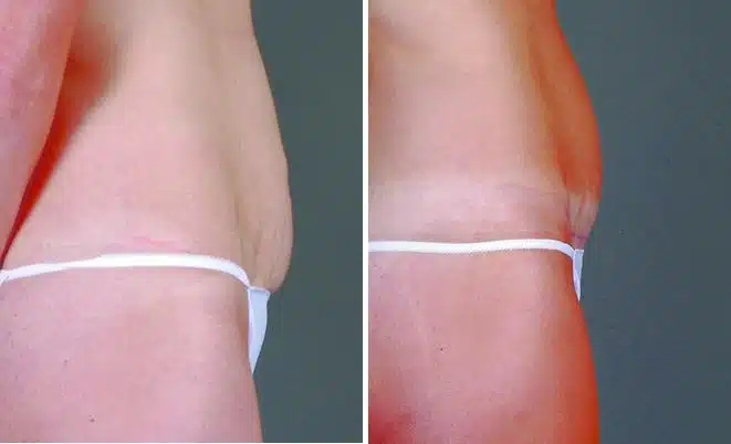 Mini Tummy Tuck Before and After Photos in Omaha, NE, Case 4319