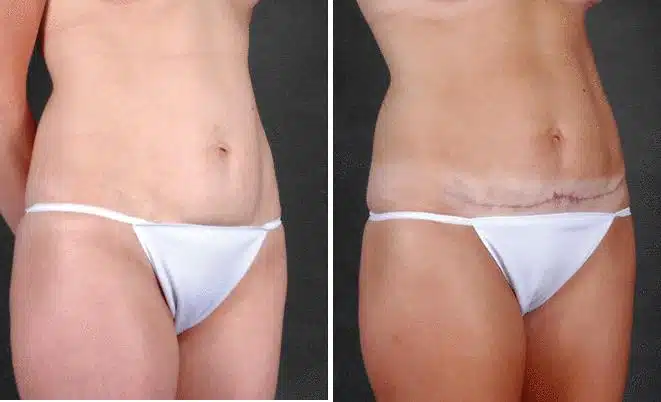 Mini Tummy Tuck Before and After Photos in Omaha, NE, Case 4319