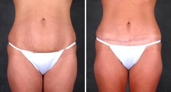 Mini Tummy Tuck Before and After Photos in Omaha, NE, Case 4346