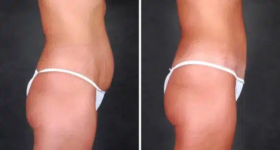 Mini Tummy Tuck Before and After Photos in Omaha, NE, Case 4346