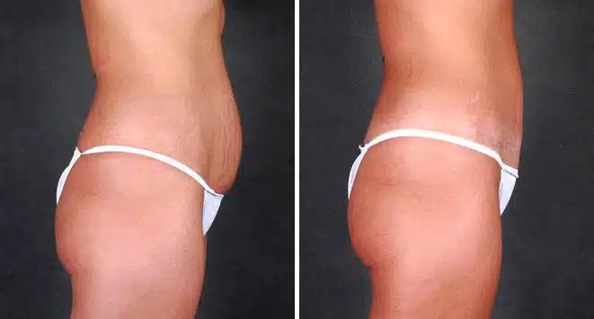 Mini Tummy Tuck Before and After Photos in Omaha, NE, Case 4346