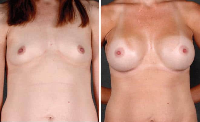 Mini Tummy Tuck Before and After Photos in Omaha, NE, Case 4319