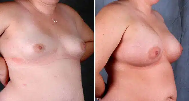 Breast Augmentation Before and After Photos in Omaha, NE, Case 4619