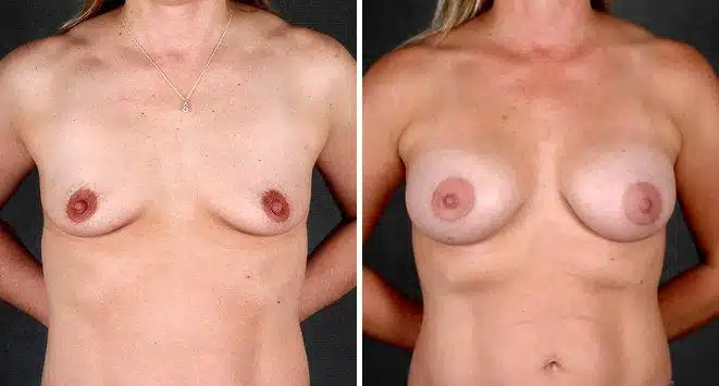 Breast Augmentation Before and After Photos in Omaha, NE, Case 4649