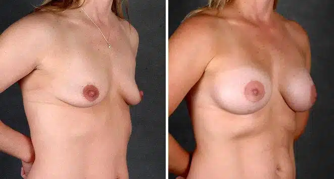 Breast Augmentation Before and After Photos in Omaha, NE, Case 4649