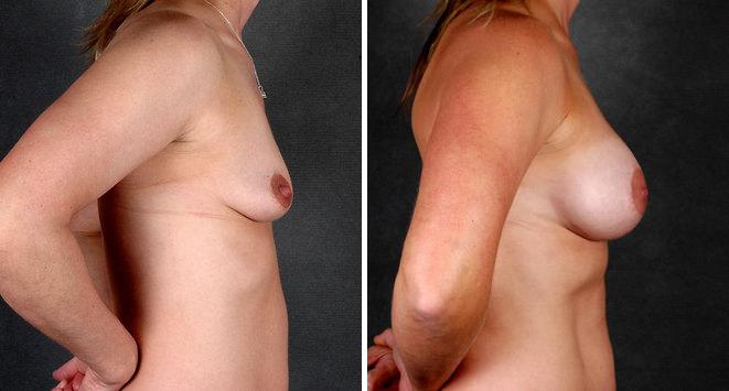 Breast Augmentation Before and After Photos in Omaha, NE, Case 4649