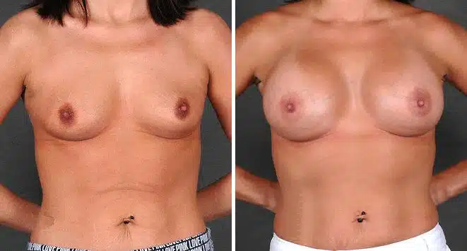 Breast Augmentation Before and After Photos in Omaha, NE, Case 4661