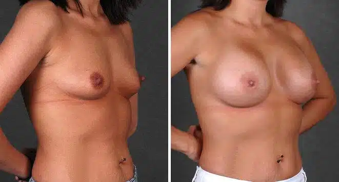 Breast Augmentation Before and After Photos in Omaha, NE, Case 4661