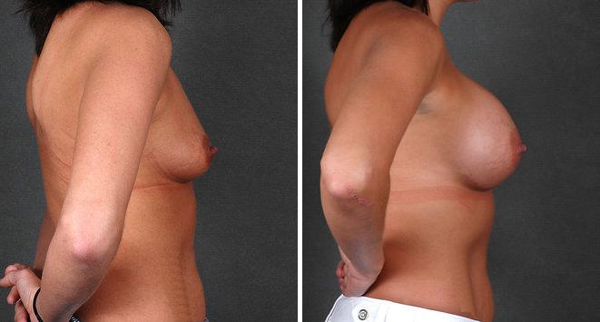 Breast Augmentation Before and After Photos in Omaha, NE, Case 4661