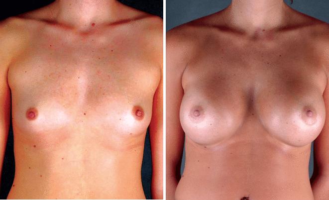 Breast Augmentation Before and After Photos in Omaha, NE, Case 4551
