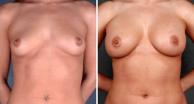 Breast Augmentation Before and After Photos in Omaha, NE, Case 4676