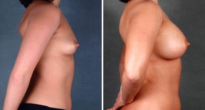 Case 4676, Breast Augmentation Before and After Photos Breast Augmentation Before and After Photos in Omaha, NE, Case 4676