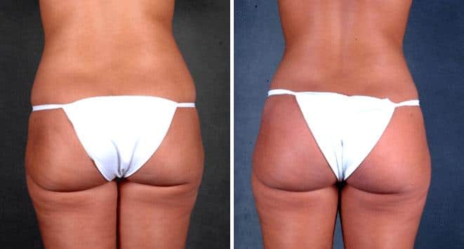 Case 4676, Breast Augmentation Before and After Photos Breast Augmentation Before and After Photos in Omaha, NE, Case 4676