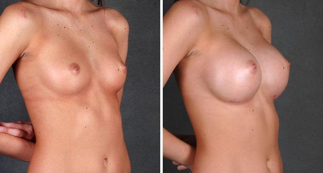 Breast Augmentation Before and After Photos in Omaha, NE, Case 4690