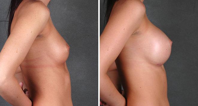 Breast Augmentation Before and After Photos in Omaha, NE, Case 4690