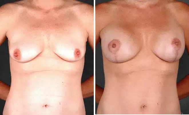 Breast Augmentation Before and After Photos in Omaha, NE, Case 4697