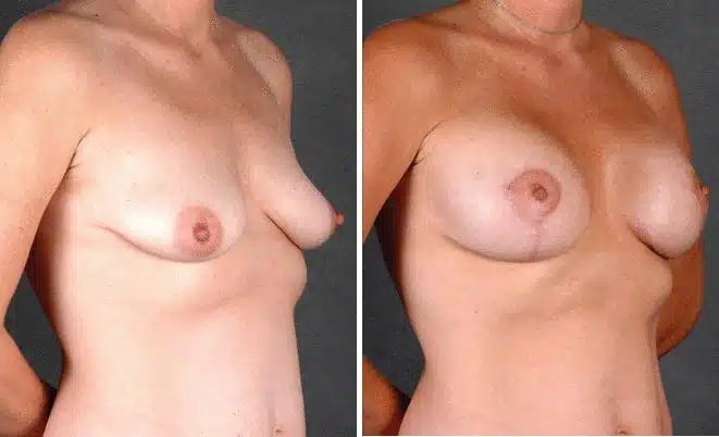 Breast Augmentation Before and After Photos in Omaha, NE, Case 4697