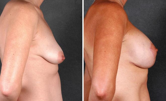 Breast Augmentation Before and After Photos in Omaha, NE, Case 4697