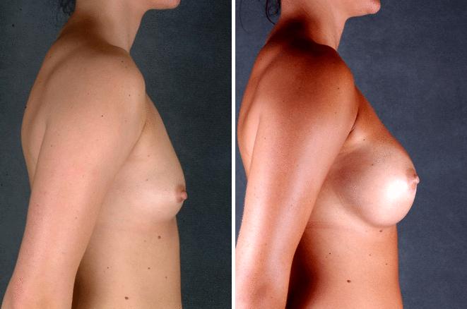 Breast Augmentation Before and After Photos in Omaha, NE, Case 4551