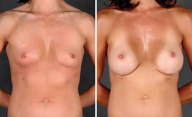 Breast Augmentation Before and After Photos in Omaha, NE, Case 4581